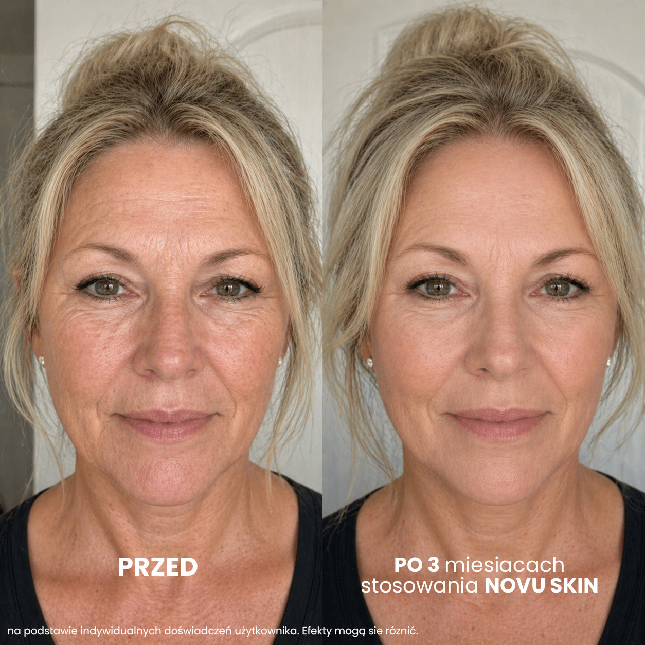 NOVU SKIN MesoInfuse – sada proti vráskám a pro hydrataci